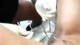 تجميع القذف الداخلي فتحات مشبعة بالنطف